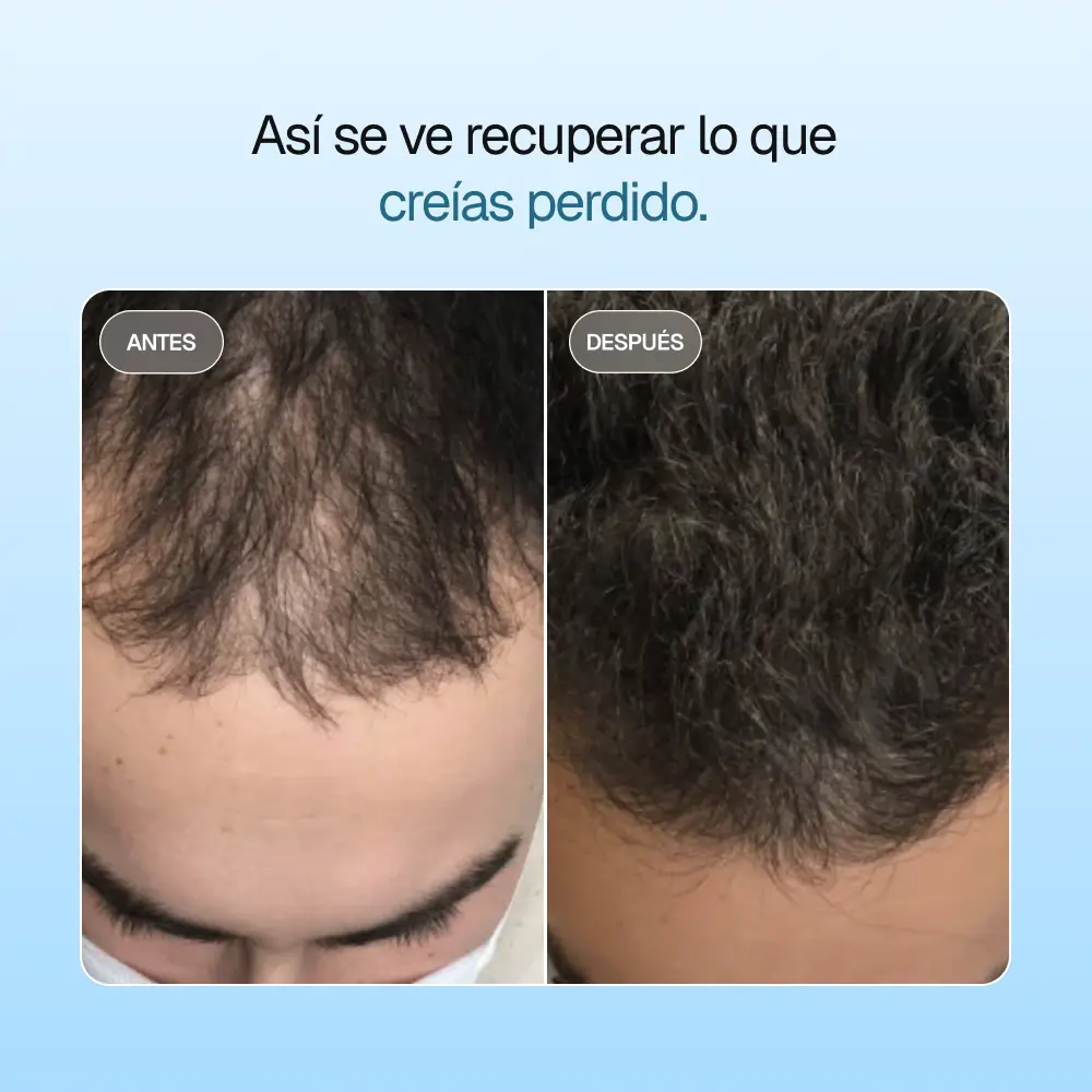 AURA® DHT Blocker – Control natural contra la alopecia androgenética