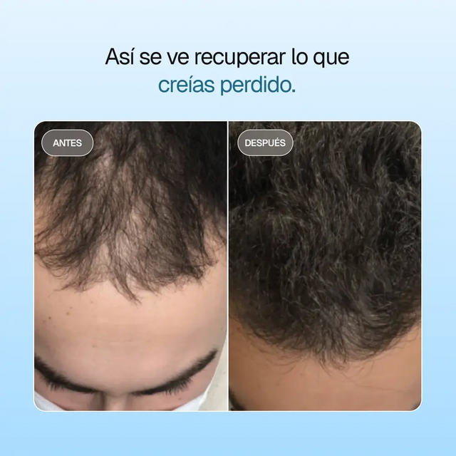 AURA® DHT Blocker – Control natural contra la alopecia androgenética